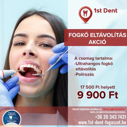 Fogkő Eltávolítás Akció Fogkő Eltávolítás Akció