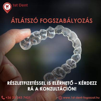 Átlátszó fogszabályozás részletfizetéssel