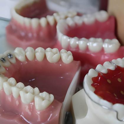 Fogszabályzó típusok: fém, porcelán, átlátszó, belső és éjszakai